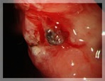 出血性胃潰瘍1.jpg